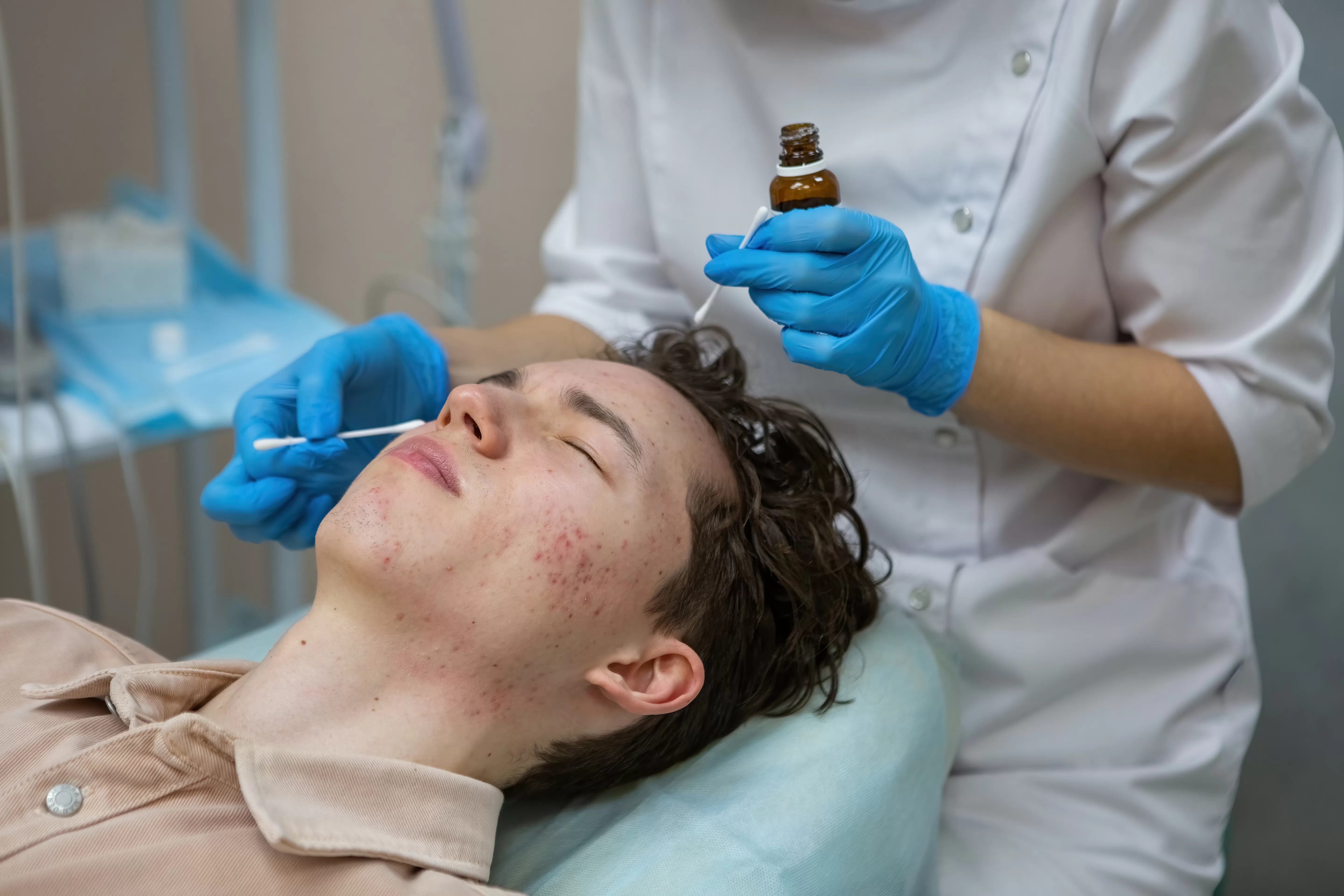 Acne treatment in a teenager.