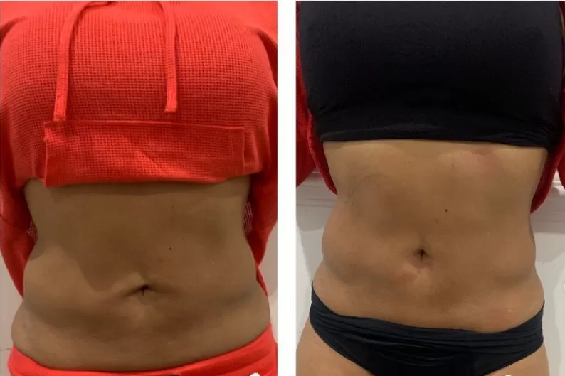 emsculpt neo results emsculpt neo results