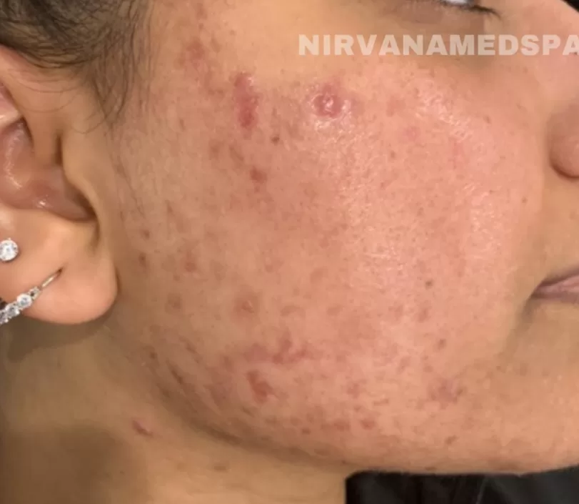 dual ipl acne treatments dual ipl acne treatments