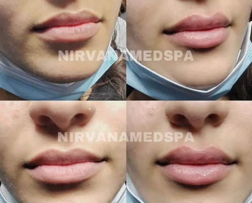 lip fillers lip fillers in palos heights